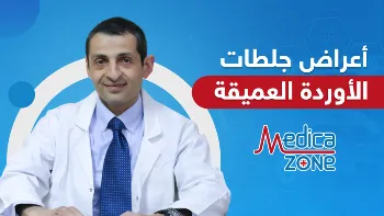 أعراض جلطة الوريد العميق في الساقين