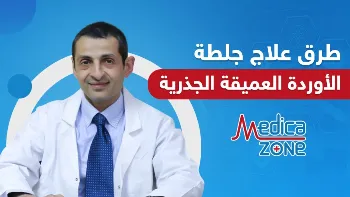 طرق علاج جلطة الأوردة العميقة الجذرية