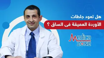 هل تعود جلطات الأوردة العميقة في الساق بعد علاجها؟