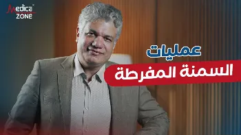 أهم معايير نجاح عمليات السمنة المفرطة