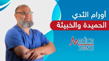 ما أعراض أورام الثدي الحميدة والخبيثة؟