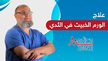 وسائل علاج الورم الخبيث في الثدي وكيفية تحديد الخيار المناسب منها