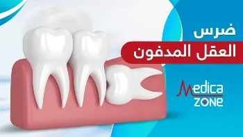 ضرس العقل المدفون وتأثيره على الأعصاب