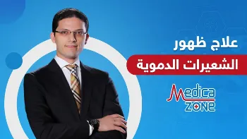 علاج الشعيرات الدموية في الساقين بين القديم والحديث