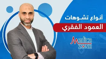 أنواع تشوهات العمود الفقري وأسبابها