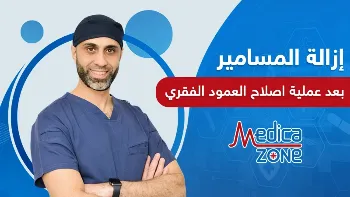 هل يجب إزالة المسامير بعد عملية العمود الفقري؟