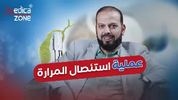 مميزات جراحة إستئصال المرارة بالمنظار