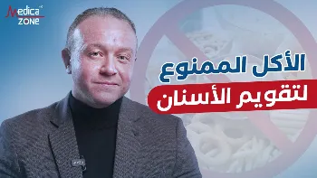 ما الاكل الممنوع لتقويم الاسنان؟