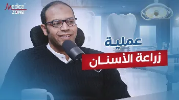 العوامل التي تؤثر في نسبة نجاح زراعة الاسنان