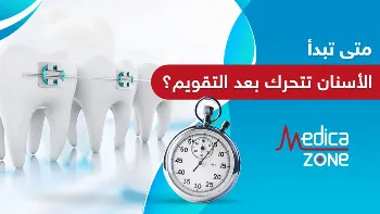 متى تبدأ الأسنان تتحرك بعد التقويم؟.. ستدهشك النتائج النهائية