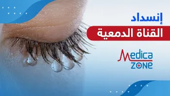 تجربتي مع انسداد القناة الدمعية