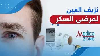 تأثير مرض السكر على العين، وأهم طرق علاج نزيف العين لمرضى السكر؟
