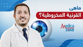 ما هي القرنية المخروطية وكيفية علاجها؟