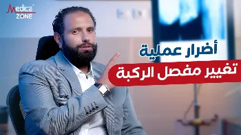 أضرار عملية تغيير مفصل الركبة