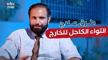التواء الكاحل للخارج