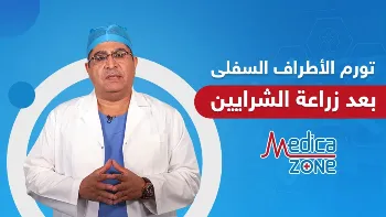 تورم الاطراف السفلى بعد زراعة الشرايين التاجية