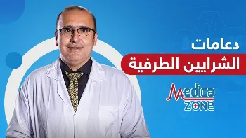 لا يمكنك الاستغناء عن دعامات الشرايين ما دمت تعاني إحدى هاتين الحالتين 