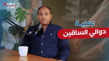 عملية دوالي الساقين