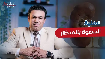 تفتيت الحصوة بالمنظار أحدث طرق العلاج بدون جراحة