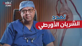 تركيب الدعامات لعلاج تمدد الشريان الأورطي: البديل عن الجراحة التقليدية