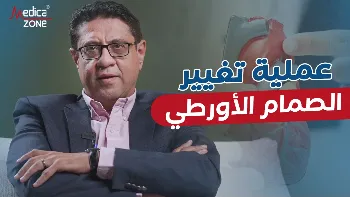 عملية تغيير الصمام الأورطي بتقنية أوزاكي: مزايا وطول عمر الصمام