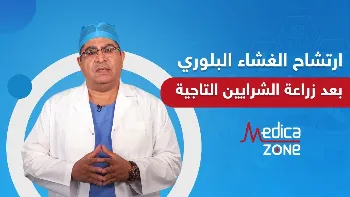 اسباب ارتشاح الغشاء البلوري بعد عملية زراعة الشرايين التاجية