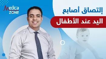 التصاق اصابع اليد عند الاطفال
