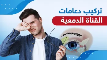 متى يلجأ المريض إلى تركيب دعامات القناة الدمعية؟