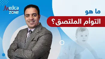 ما هو التوأم الملتصق؟ ومتى تستدعي الحالة التدخل الجراحي؟