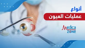 انواع عمليات العيون لتصحيح عيوب الإبصار