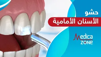أفضل أنواع حشو الأسنان الأمامية