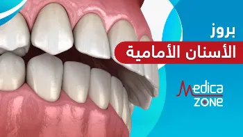 دور موسع الفك في علاج بروز الأسنان الأمامية بدون تقويم